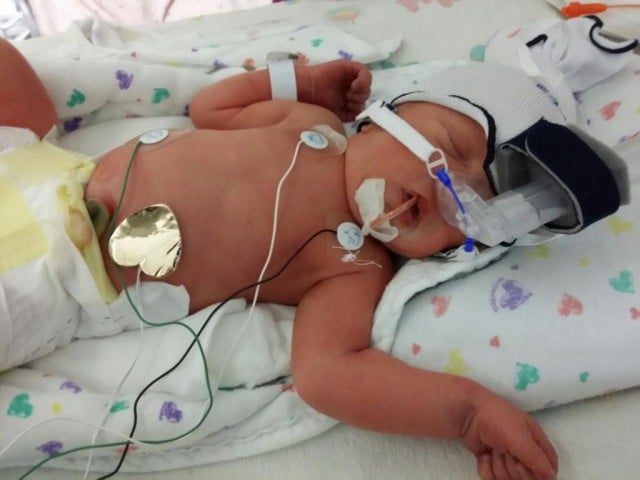 A tiny baby hooked up to a breathing machine